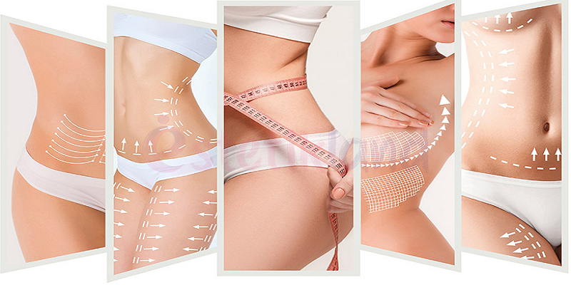 Liposuction Nedir? Liposuction (Yağ Alma Ameliyatı) Kimlere yapılabilir?