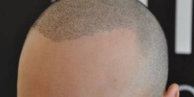 Saç ekimi sonrasında dikkat edilmesi gereken hususlar nelerdir?