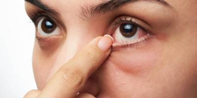 Göz alerjisi nedir? Göz alerjisi belirtileri nelerdir? Mevsimsel göz alerjisine dikkat!