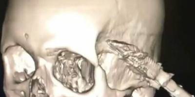 Uyuduğu koltuktan düşen kişinin başına soba maşası girdi