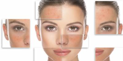 Yağlı Cildi Dengelemek İçin Uzman Öneriler