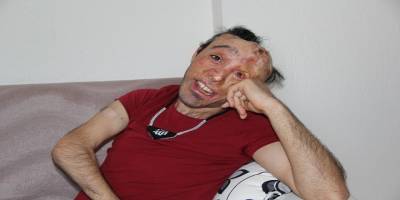 İzmir’de 6 aylıkken yüzü yanmıştı, operasyonuna korona engel oldu