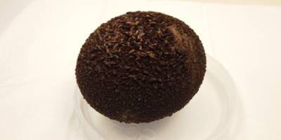 Mesanesinden 8 santimlik taş çıktı