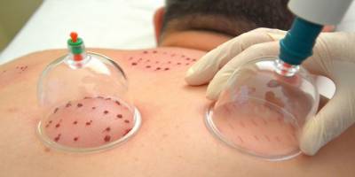 Hacamat yapmanın da bir günü var! Hacamat hangi gün yapılır? Hacamat 2020 Takvimi