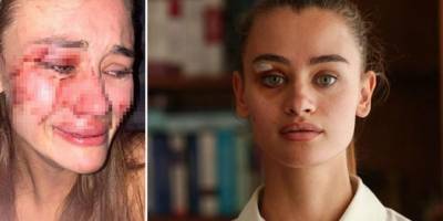 Şeyma Subaşı’nın Yakın Arkadaşı Feci Şekilde Darp Edildi, Sosyal Medya Sallandı!