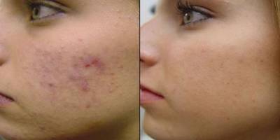 Cilddeki Lekeleri Nasıl Yok Edebiliriz? Vücuttaki Lekelere Dikkat