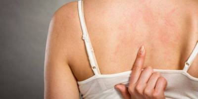 Zona Hastalığı Nedir? Zona Hastalığı Belirtiler ve Tedavisi…. Evde Nasıl Tedavi Edilir?