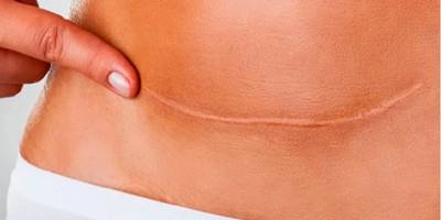 Doğum sonrası oluşan sarkmalar nasıl engellenir?