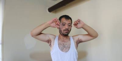 9 yıldır Hidradenitis hastası Enver Dağtekin tedavi olmak istiyor