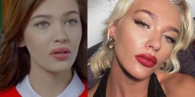 Ünlü Oyuncu Melisa Döngel bin pişman oldu! yüzündeki dolguları erittirdi!