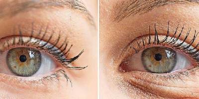 Göz Altı Torbaları İçin Ameliyatsız Tedavi Yöntemleri Nelerdir?